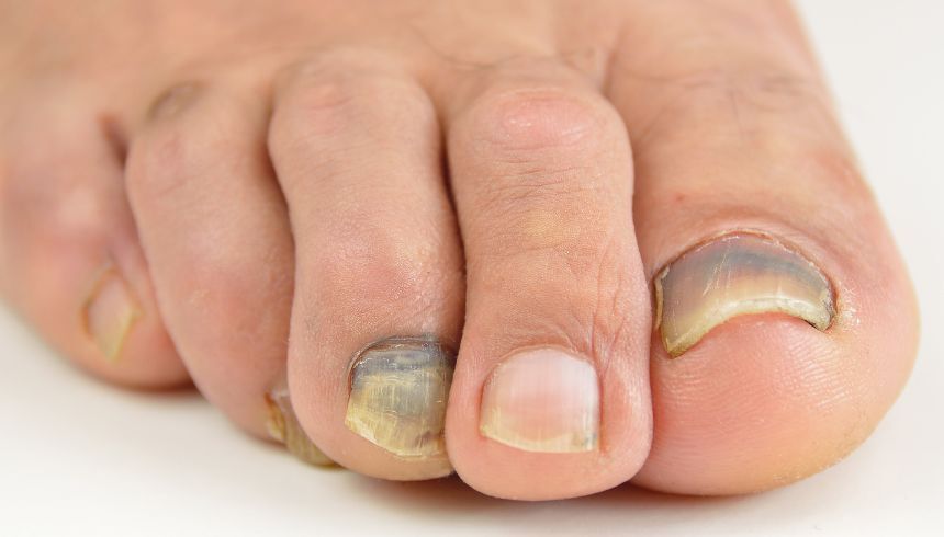 Eerste hulp bij een blauwe nagel · Gezondheid en wetenschap